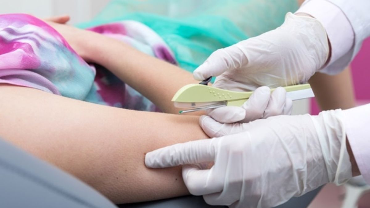 Implante contraceptivo hormonal será obrigatório em planos de saúde